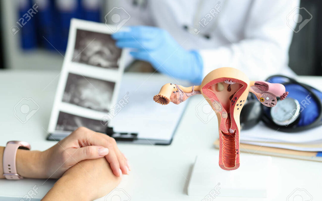 What to Expect During and After Uterine Fibroid Embolization Recovery