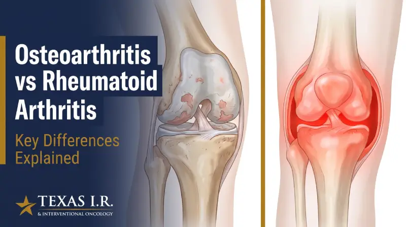 Osteoarthritis vs Rheumatoid Arthritis